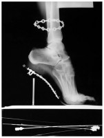 helmut-newton-x-ray-of-high-heeled-shoe-and-cartier-bracelet-paris-1994.jpg